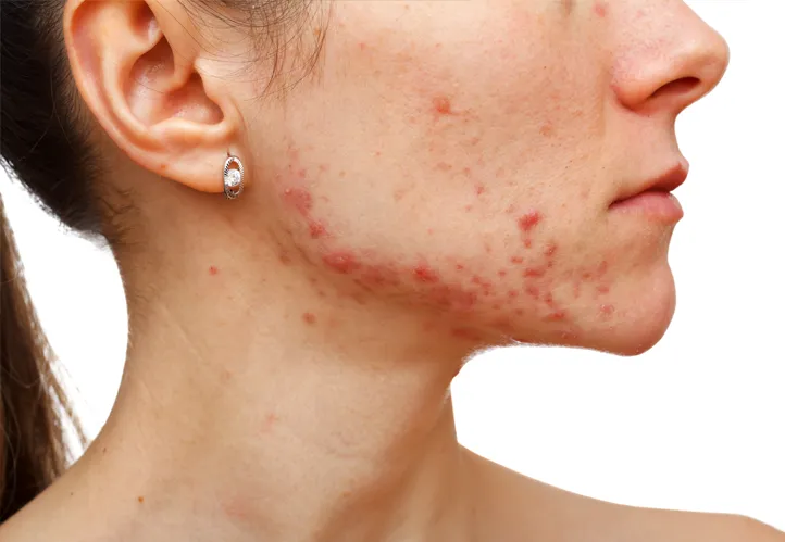 Acne Treatment Featured Image