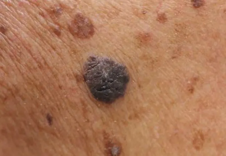 Dermatology Surgical Mole Removal Featured Image
