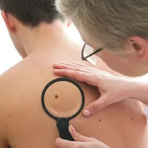 Dermatology Surgical Mole Removal