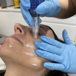 skin needling treatment in aylesbury bucks