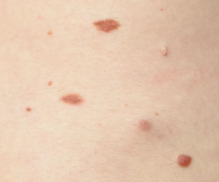 Skin Tag Wart And Milia Removal Featured Image