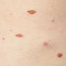 Skin Tag Wart And Milia Removal