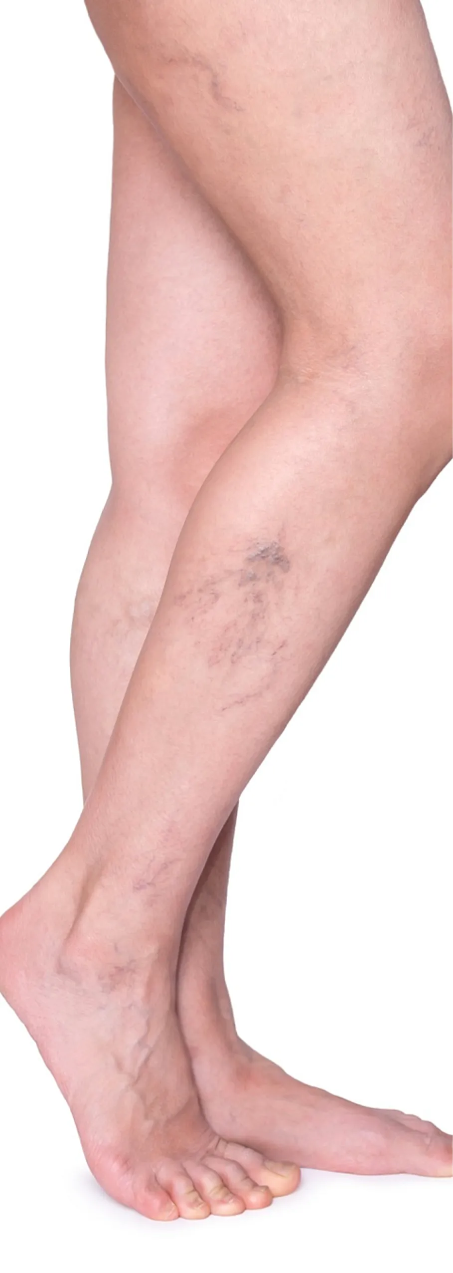 Thread Vein Removal Solutions