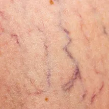 Vein Minimisation And Removal