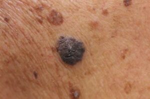 mole removal skin cancer removal aylesbury buckinghamshire 